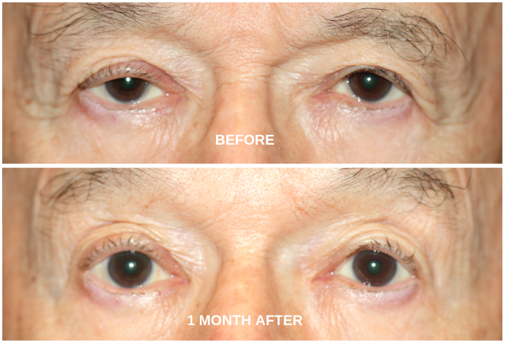 Ptosis Surgery Droopy Eyelid Repair Milan Eye Center 