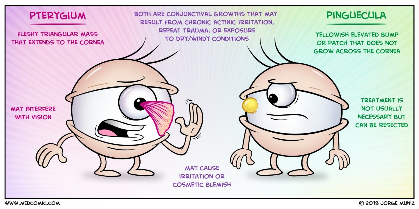 Pterygium Vs Pinguecula | Milan Eye Center