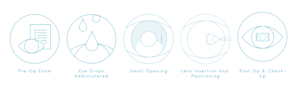 Implantable Contact Lens (ICL) | LASIK Eye Center | Milan Eye Center